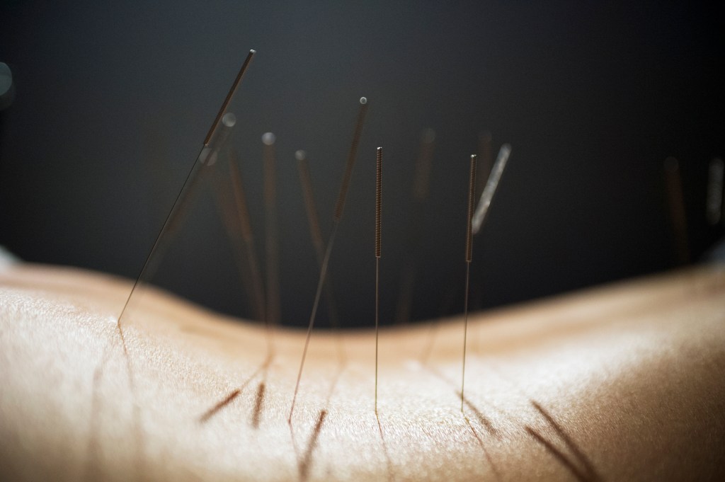 Midsection of person with acupuncture needles on back against black background 6 terapias alternativas que prometem melhorar a energia